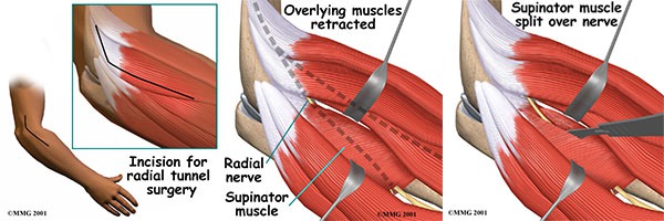 RADIAL TUNNEL SYNDROME